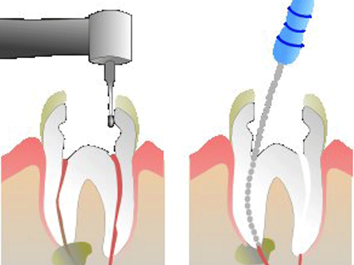 Как удаляют нерв зуба фото Pearl Dental Care sri lanka Home Page